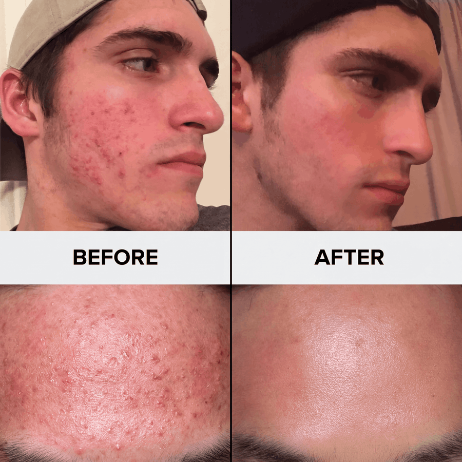 Before and after: real customer, cheek and jaw, unedited