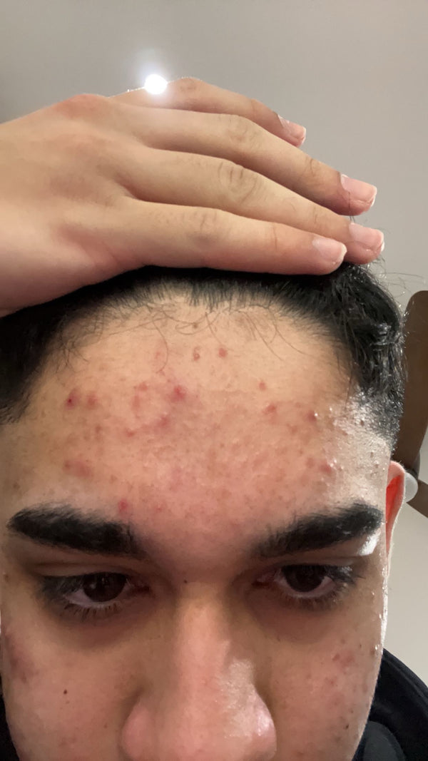 Skin before using Sanora