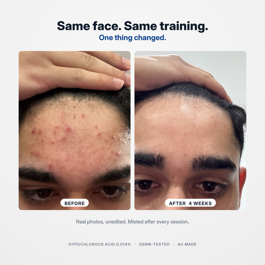 Forehead before and after four weeks of SANORA
