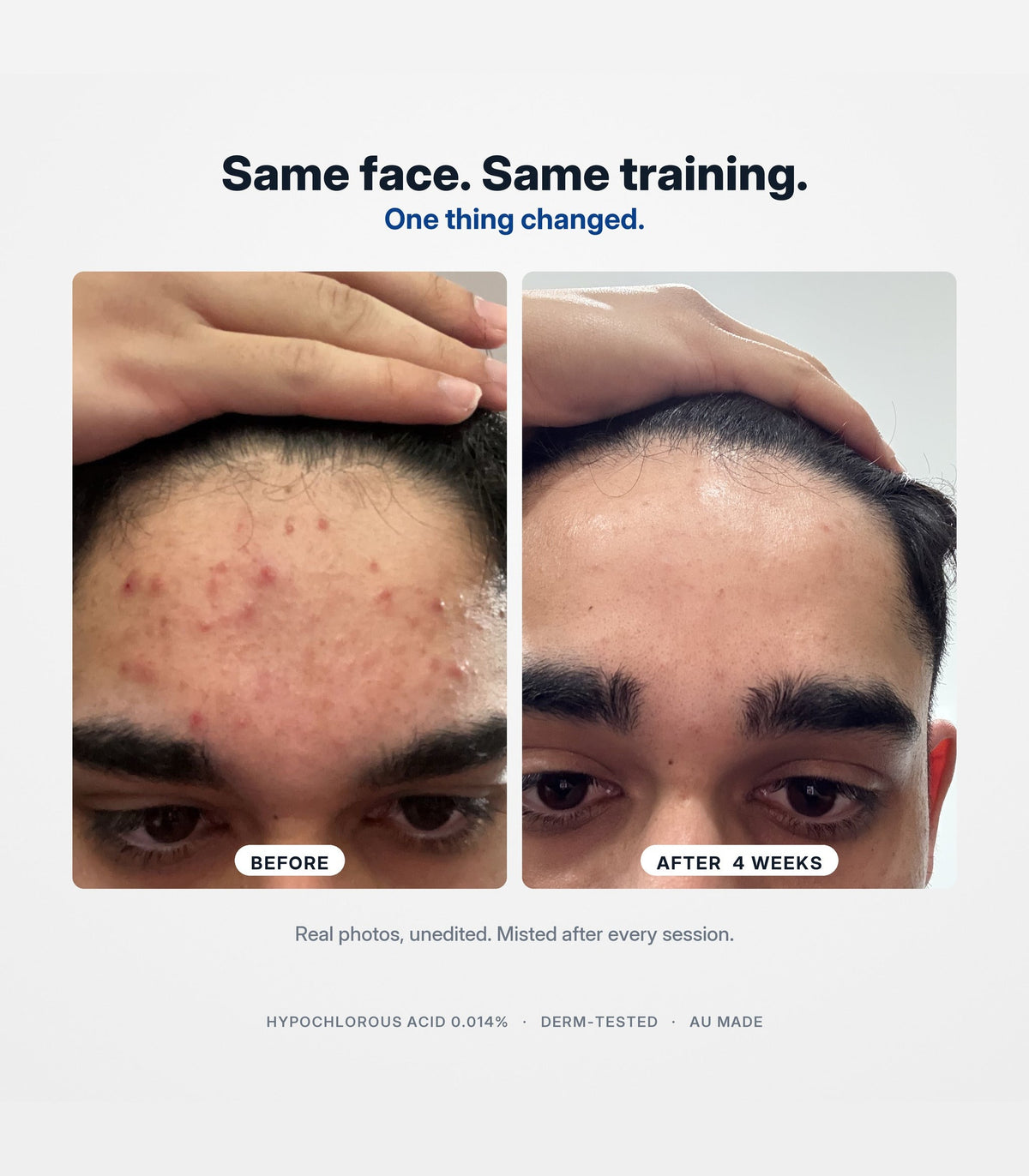 Forehead before and after four weeks of SANORA, real customer photos, unedited