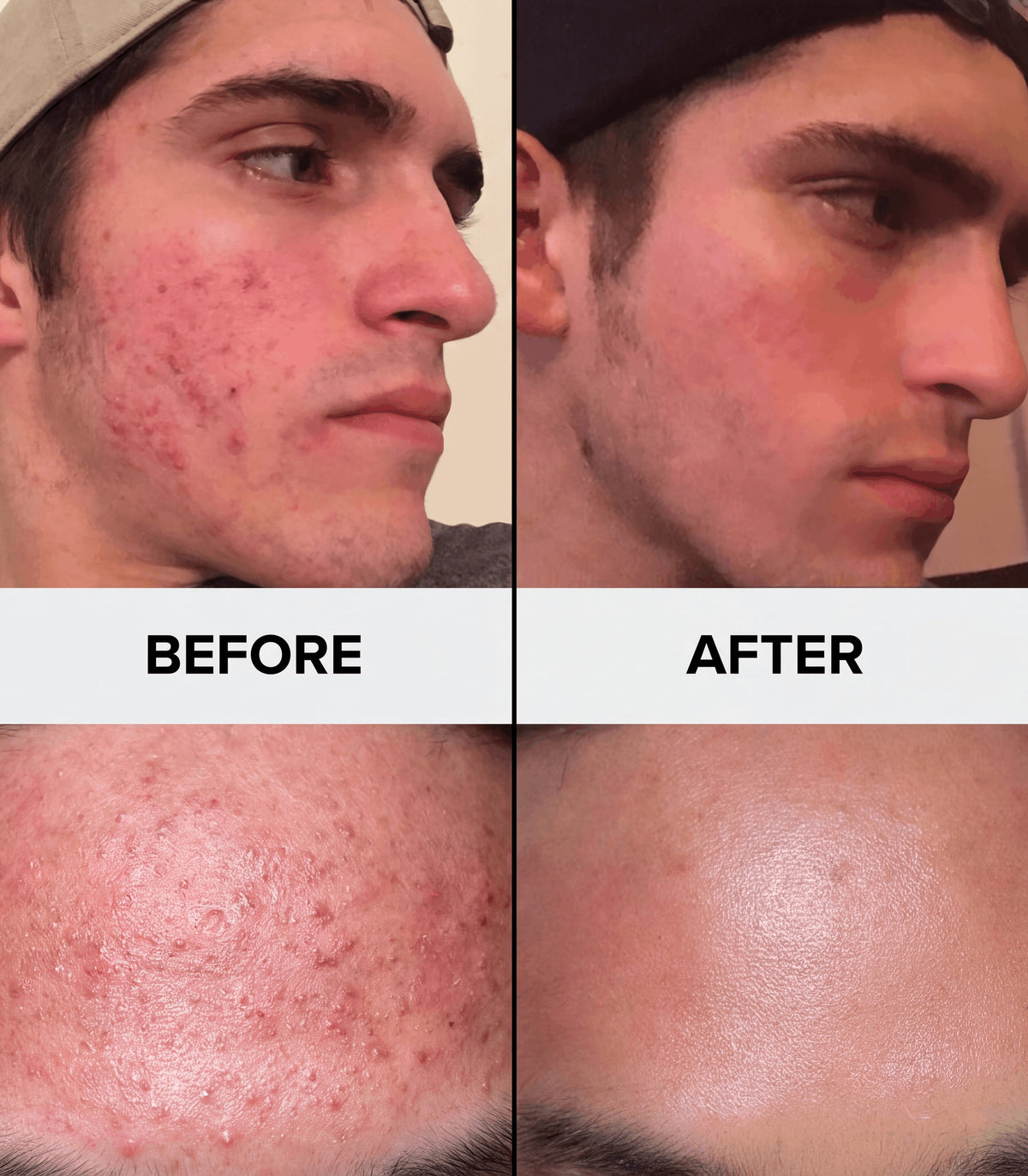 Before and after: real customer, cheek and jaw, unedited