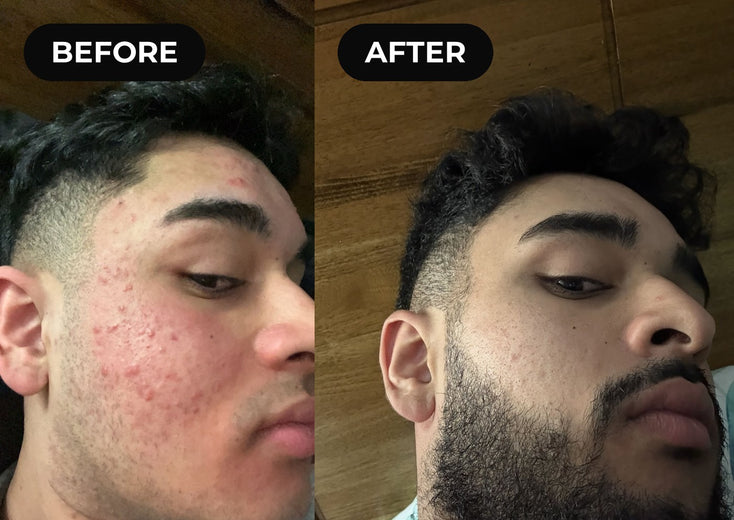 Before and after hypochlorous acid: cheek breakouts