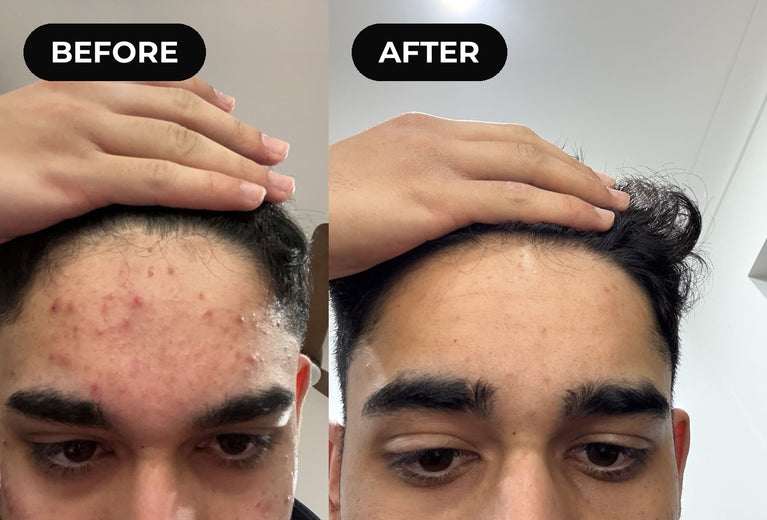 Before and after hypochlorous acid: forehead breakouts