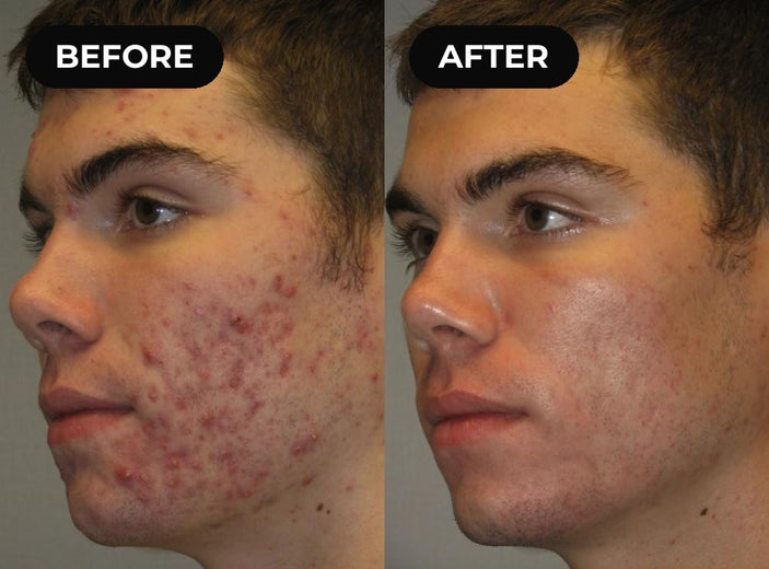 Before and after hypochlorous acid: severe cheek breakouts