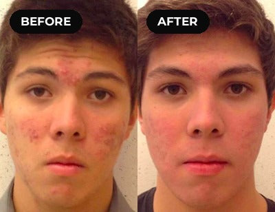 Before and after hypochlorous acid: breakouts across the face