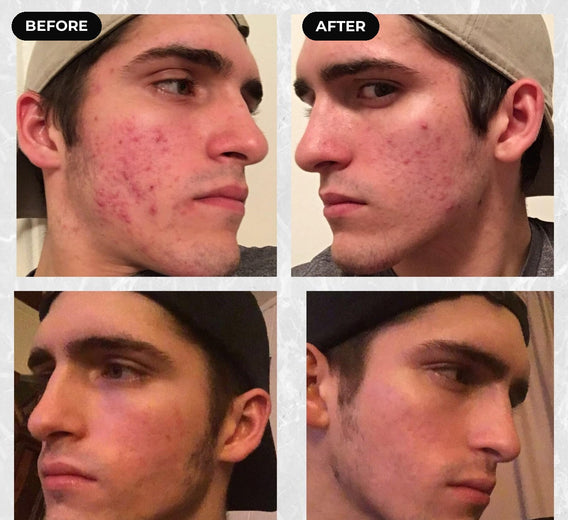 Before and after hypochlorous acid: cheek and jaw breakouts
