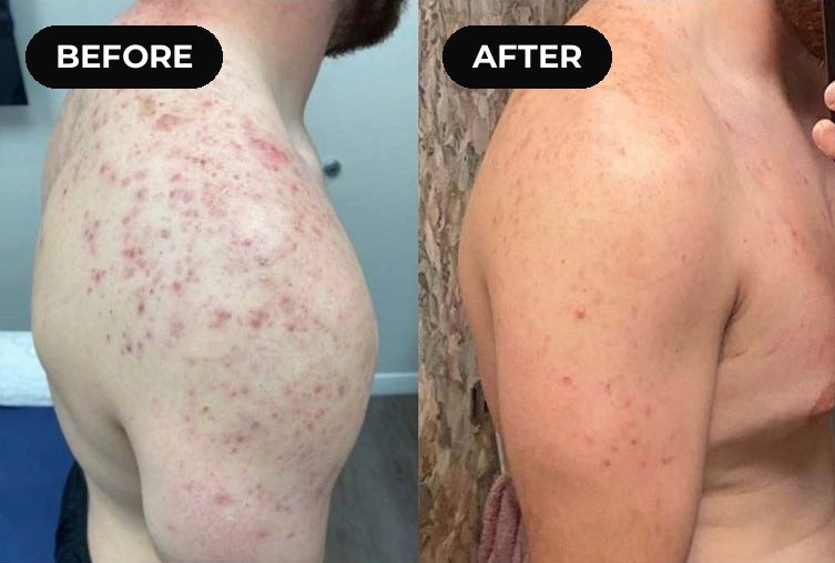 Before and after hypochlorous acid: shoulder breakouts