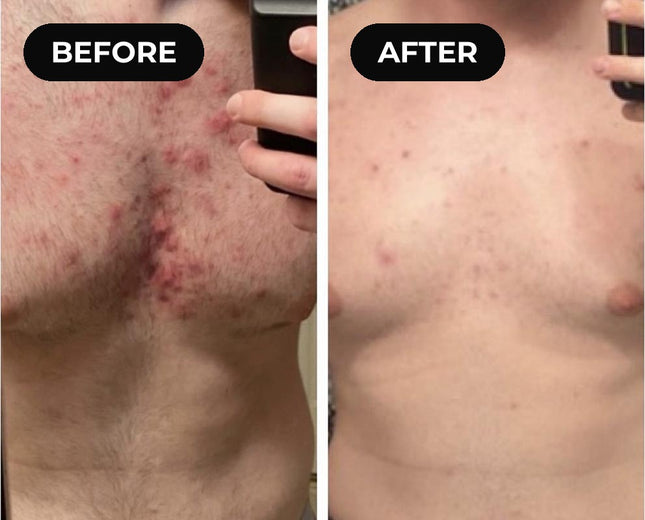 Before and after hypochlorous acid: chest breakouts