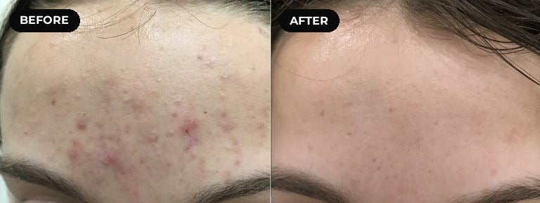 Before and after hypochlorous acid: forehead breakouts