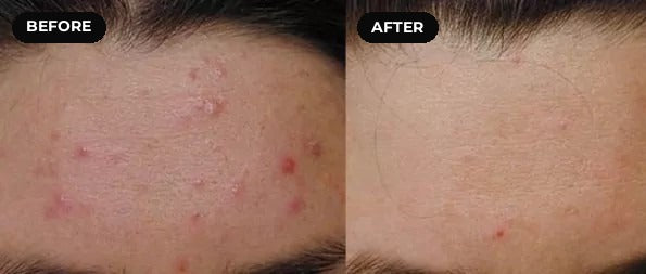 Before and after hypochlorous acid: forehead breakouts