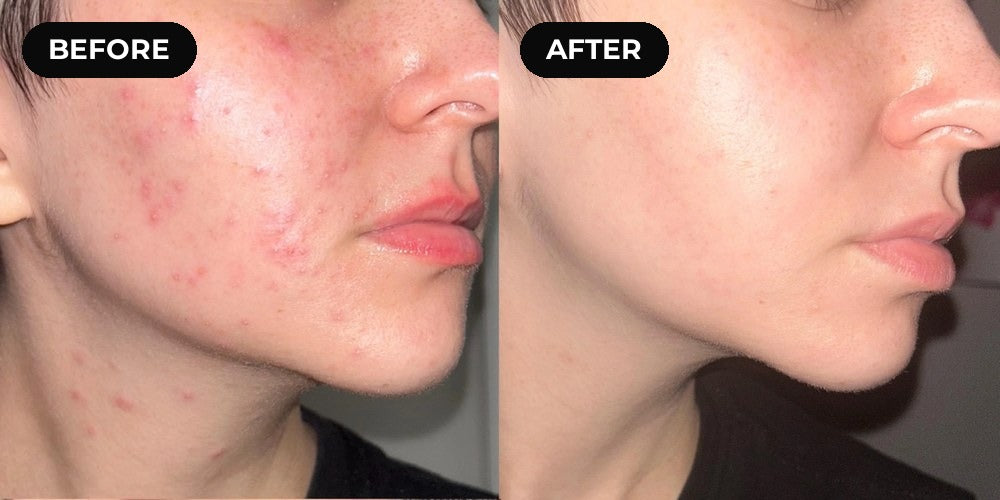 Before and after hypochlorous acid: cheek breakouts